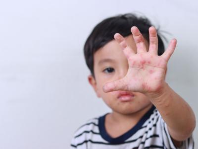 Kitakind hat einen Ausschlag auf der Hand